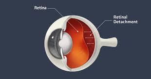 Detached Retina Also Retinal Detachment Allaboutvision Com