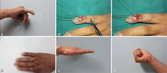 Heidi said just moving around is helping her to get back to normal. Case 3 A Preoperative View Of The Patient With Chronic Mallet Finger Download Scientific Diagram