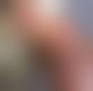 Image result for Probe-to-Bone Test