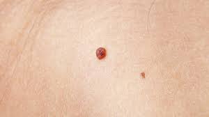 Check spelling or type a new query. Unsightly Skin Tags Your Doctor Can Help