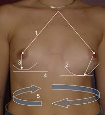 According to reports in the medical literature, poland syndrome appears to be three times as common in males as females. Idiopathic Scoliosis And Breast Asymmetry Journal Of Plastic Reconstructive Aesthetic Surgery