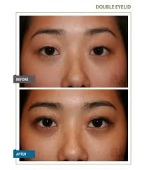 Small eyes and eyes with no folds are a physical characteristic that is not preferred by most of the asian women. Asian Double Eyelid John Kang Md F A C S Jk Facial Plastics Reconstructive