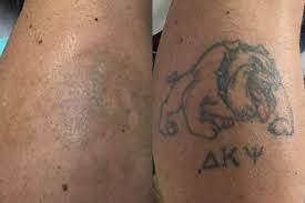 More and more people receive laser treatment each year. AnecdotÄƒ Volei Sf Before And After Laser Tattoo Lmvdesigns Com