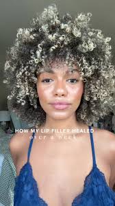 My lip filler healing journey @Dr Roger Tsai, Plastic Surgery #lipfiller  #lipfillerresults #lipfillerbeforeandafter #lipfillerblackgirl