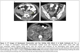 Image result for Neutropenic Colitis