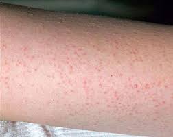 It is usually found on the outer areas of the upper arms, thighs, and cheeks. Keratosis Pilaris Huid Laser Utrecht