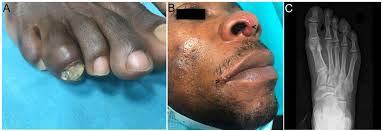 Image result for Dactylitis