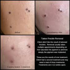 Before and after tattoo removal photos are taken during every session so clients can track their results throughout the process. Tattoo Removal Permanent Makeup Correction Results About Face And Body
