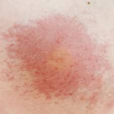 Bites That Look Like Mosquito Bites Wasp Sting Allergic Reaction Identifying Bug Bites Types Of Bug Bites Bug Bites