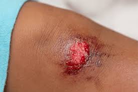 Image result for Wound