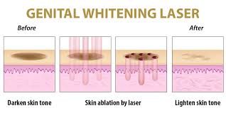 Genital Skin Whitening Whitening Laser