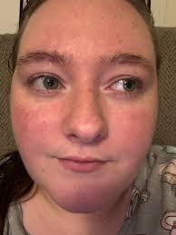 Experiencing red, itchy, and dry cheeks after surgery?