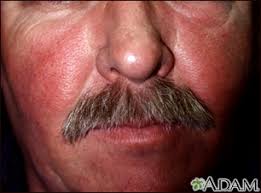 Image result for red rash face