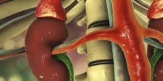 Penyakit batu karang (kidney stone) boleh menyebabkan sakit belakang yang amat sangat hingga digambarkan lebih teruk berbanding sakit bersalin! Penting Tanda Tanda Batu Ginjal Ini Bisa Anda Identifikasi Sendiri