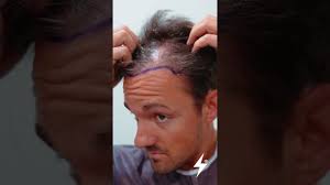 Hair Transplant