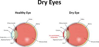 Dry Eye Fry Eye Associates