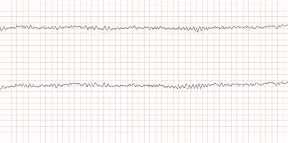 Image result for Ventricular Fibrillation