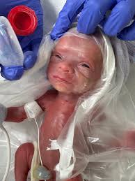 Advocating for NICU baby discharge with feeding concerns