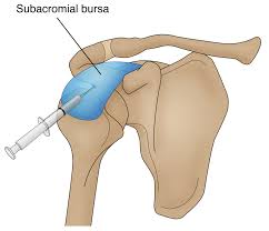 Image result for Subacromial Space Injection