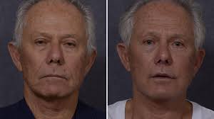 We did not find results for: Male Rhinoplasty Sydney By Renowned Plastic Surgeon Dr Hodgkinson