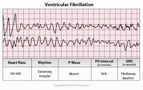 Vfib Ekg Ecg Interpretation Course Nursing Continuing Education Ce Nurse Ecg Interpretation Continuing Education For Nurses Ekg