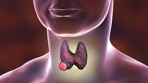 Cancer gives most people no symptoms or signs that exclusively indicate the disease. If You Have A Lump In Your Neck It Could Be Thyroid Cancer