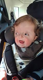 Request for photo edit for child with Apert syndrome