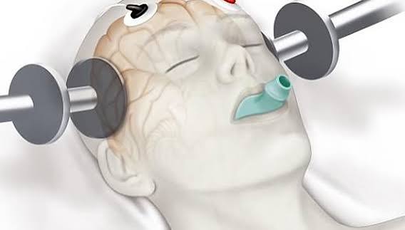 How close is TMS to Shock Therapy?