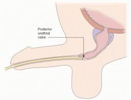 Posterior Urethral Valves Abdominal Key