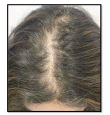 Furthermore, healthy tresses indicate health and youth. Female Pattern Hair Loss Canadian Hair Loss Foundation