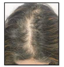 Patients with hypothyroidism or hyperthyroidism notice a gradual thinning of their hair rather than localized bald spots or missing patches. Female Pattern Hair Loss Canadian Hair Loss Foundation