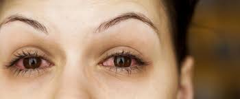 La gonorrhée est une infection transmise sexuellement causée par la bactérie neisseria gonorrhea ; Vos Yeux Et Les Its The Canadian Association Of Optometrists