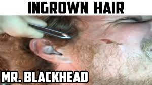 We did not find results for: Ingrown Hair 2020 Longest Ingrown Hair On Youtube Youtube