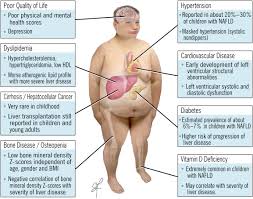 Primary liver cancer is an uncommon but serious type of cancer that begins in the liver. Nonalcoholic Fatty Liver Disease In Children Pediatric Clinics