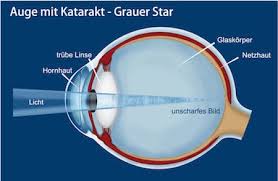 Cataracts often develop slowly and can affect one or both eyes. Grauer Star Operation In Berlin Dr Med Febrer Bowen