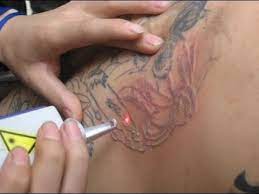 See hot celebrity videos, e! Laser Tattoo Removal In Andheri Mumbai India Alluremedspa Youtube