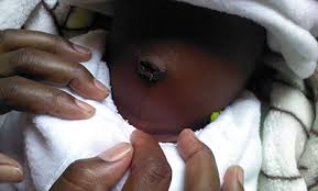 Umbilical cord care can sound intimidating, but it doesn't have to be. Umbilical Cord Antiseptic Not Effective In Reducing Infant Deaths In Africa Sph