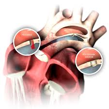 Pda is a global provider of science, technology, and regulatory information for the pharmaceutical & biopharmaceutical communities. Heart Defect Pda Occlutech Perfecting Performance