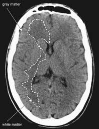 Image result for CT Head