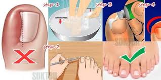 Oltre Ad Essere Un Visibile Fastidio Estetico Le Unghie Incarnite Non Curate Possono Procurare Dolori Gonfiore E Perfino Infez Unghie Incarnite Unghie Rimedi