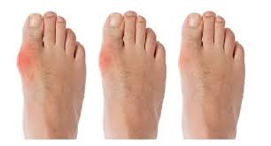 Corretor De Joanete - Hallux Noturno Orthopauher