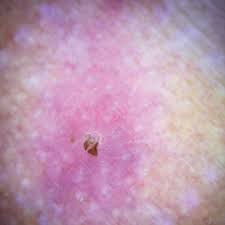 Image result for Myiasis