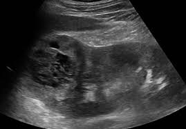 Renal cell cancer • recurrence • detection • ultrasound •. Urinary Tract And Male Reproductive System 2 1 Kidney And Ureter Case 2 1 6 Renal Cell Carcinoma Spreading And Local Recurrence Ultrasound Cases