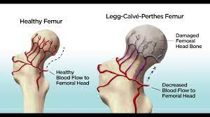 The osteochondroses typically are characterized by degeneration and subsequent regeneration of the. Legg Calve Perthes Disease Gillette Children S Specialty Healthcare