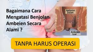Pin Di Anus Terasa Nyeri Berdenyut Disertai Sulit Bab