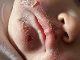 Image result for yellow scabs on the face in children