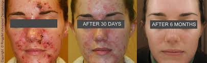 Acne Treatment Philadelphia Mainline Pa
