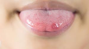 Check spelling or type a new query. Canker Sore On Tongue Pictures Causes And Treatments