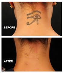 We are here to give you the facts and information you need on. Unwanted Tattoo Removal