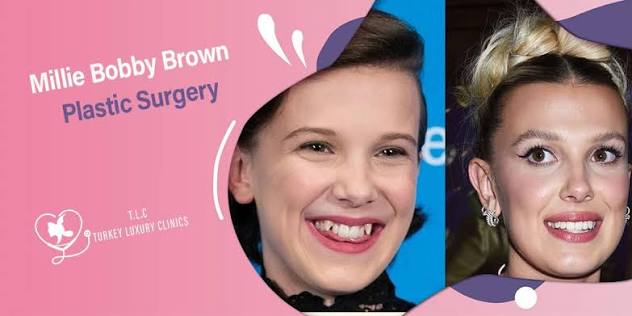 Millie Bobby Brown Plastic Surgery: Rumors vs. Reality with Photos